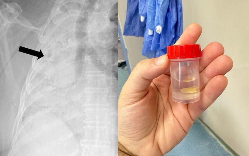 Nefes borusuna kaçan mısır tanesi çıkarıldı